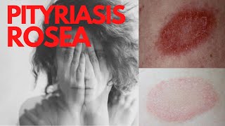 PITYRIASIS ROSEA  Answers of the common questions about Pityriasis Rosea What is Pityriasis rosea [upl. by Annawyt]