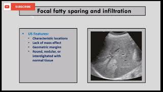 Ultrasound of diffuse liver diseases abdomen ultrasound [upl. by Wolfe]