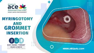 Bilateral Myringotomy and Ventilation Tube Grommet Insertion [upl. by Aihsenot]