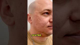 Peeling de Ácido Tricloroacético em cicatriz de acne peelingquimico peelingtca acidoata shorts [upl. by Nadean]