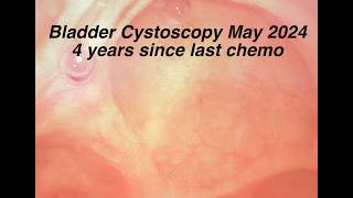 Bladder Cystoscopy 4 Years after Chemo Ended May 2024 [upl. by Afatsuom381]