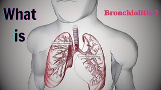 Chronic Bronchitis The Hidden Breathing Struggle Millions Face Every Day  Modern Medicine [upl. by Anned]