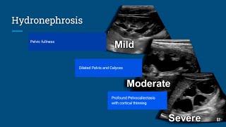 Hydronephrosis Ultrasound [upl. by Dreda709]