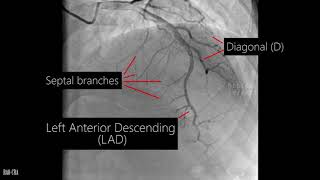 Coronary artery anatomy  Coronary angiogram [upl. by Alam]