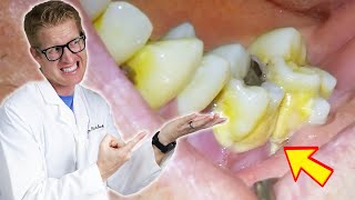 Patients Tooth FALLS OUT During Deep Cleaning TONS OF PLAQUE TARTAR amp GROSS Bacteria Removed [upl. by Takeo]