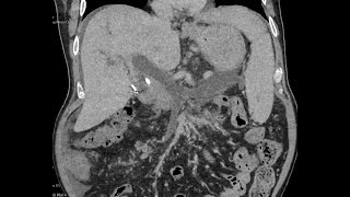 Portal  splenic  superior mesenteric vein thrombosis extensive  CT [upl. by Attaynek877]