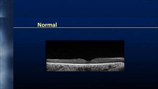 Vitreoretinal interface [upl. by Bellis]