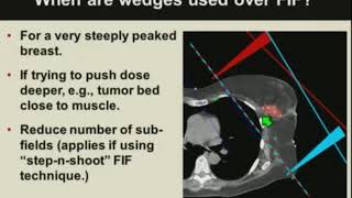 Basics of Breast Cancer Radiotherapy Treatment Planning [upl. by Perlman]