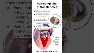 Mitral stenosis in adults [upl. by Bettzel65]