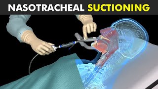 How Nasotracheal Suctioning Is Performed [upl. by Eisnyl784]