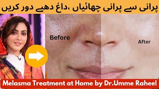 DrUmme Raheel Home Remedy💯 To Remove Pigmentation Melasma Dark Spots At Home  DrTanyahere [upl. by Song195]