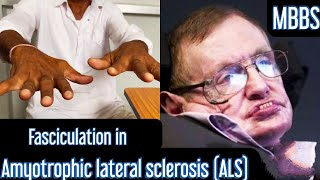 Fasciculation in Amyotrophic lateral sclerosis ALS mbbs medicine neet usmle aiims next [upl. by Eimorej]