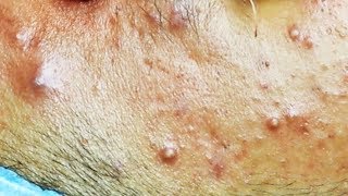 Extraction dacné kystique et pustule  cystic acne [upl. by Alyahsat]