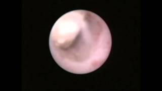 Parotid calculus removal Sialendoscopy [upl. by Airamat451]