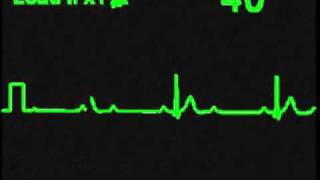 2nd Degree 21 AV Block  ECG Simulator  Arrhythmia Simulator [upl. by Calderon]