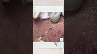 Big Cystic Acne Blackheads Extraction Blackheads amp Milia Whiteheads Removal Pimple Popping shorts [upl. by Bohannon]