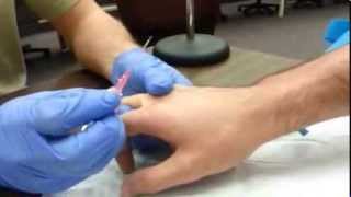 How to start an IV Dorsum of hand [upl. by Metcalf]