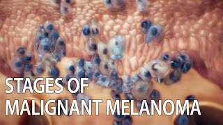 Malignant melanoma animation  skin cancer  SkinCancer MalignantMelanoma MelanomaAwareness [upl. by Yseulte]