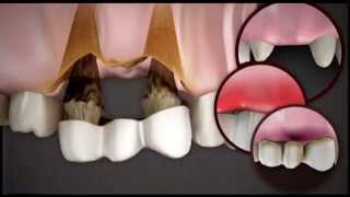 Brak pojedyńczego zęba  most a implant [upl. by Nimajneb]
