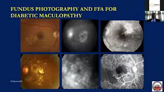 Diabetic Macular Oedema the current practice [upl. by Robinette]