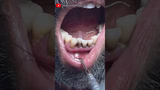 Extraction of Decayed Front Aesthetic Teeth toothextraction rootcanaltreatment dentistry [upl. by Atiken]