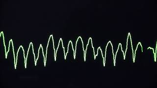 Cardiac arrest rhythms VF VT Asystole and PEA [upl. by Atinnek]