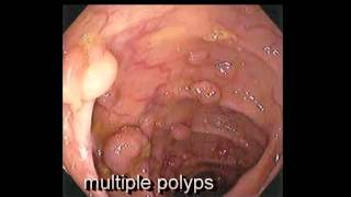 Colonoscopy FollowUp of Colon Polyp  Los Angeles Colonoscopy [upl. by Burne]