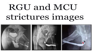 RGU and MCU strictures images [upl. by Lerual]