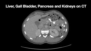 Anatomy of the Liver Gall Bladder Pancreas and Kidneys on CT [upl. by Yrrak]