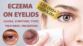 Eczema on Eyelids 2022  2023  Causes Symptoms Types Treatment and Prevention [upl. by Lenz]