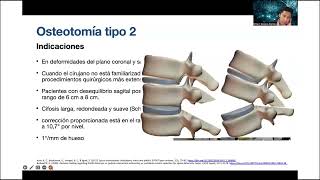 SPINE WEBINAR 70 OSTEOTOMIAS PARA CORRECCION DE DEFORMIDADES ESPINALES [upl. by Lamoree]