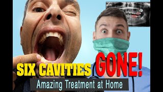 The Treatment for Tooth Decay that Reversed my 5 Cavities in 3 Months [upl. by Corene]