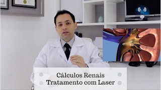 Pedras nos rins  Tratamento com Laser [upl. by Kcireddor]