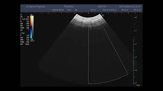 feline echo congenital heart disease Made with Clipchamp [upl. by Strawn212]