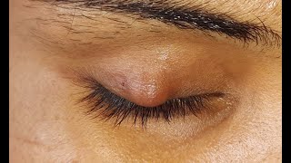 Chalazion Incision amp Curettage HD [upl. by Aneloaup]