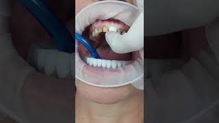 Temporary Cementation of Single Metal Ceramic Crowns shorts [upl. by Lauri768]