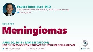 Meningiomas  Dr Rodriguez Hopkins NEUROPATH [upl. by Lemraj]