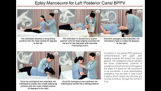 Epley Manoeuvre for Left Posterior Canal BPPV [upl. by Enra]