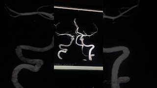 MRI scan  mri angiography  MR angiogram of brain viral trending shorts [upl. by Al224]