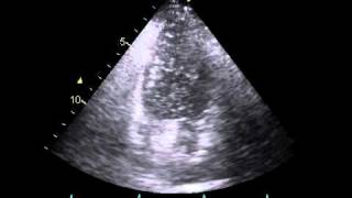 Patent formamen ovale PFO with severe rightleft shunt [upl. by Aninat]