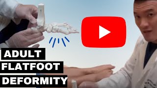 Adult Flat Foot Deformity Posterior Tibial Tendon Dysfunction Secrets [upl. by Rustice244]