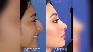 1 Year Post Primary Rhinoplasty  Before and After  Nose Transformation NOSEBYGHAVAMI Dr Ghavami [upl. by Katti]