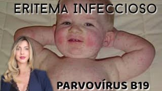 Parvovírus B19  Eritema Infeccioso [upl. by Ahsinrev]