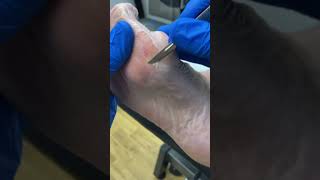 Dive into a fascinating podiatry procedure down under Watch a bunion callus meet its match [upl. by Yanad25]