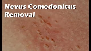 Nevus Comedonicus Removal  9 minutes worth [upl. by Eniarda]