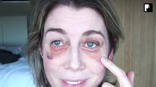 Blepharoplasty Video Diary  2 Weeks After Surgery 10 of 15 [upl. by Anolla]