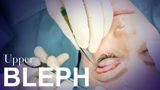 Upper Eyelid Blepharoplasty [upl. by Atsed547]