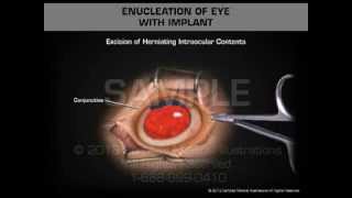 Enucleation of Eye with Implant [upl. by Mccandless]