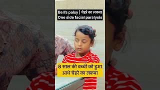 8 साल की बच्ची को हुआ चेहरे का लकवा  Bell’s palsy  bellspalsy facialparalysis paralysis [upl. by Drucy]