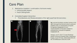 Acute Limb Ischemia [upl. by Luz]